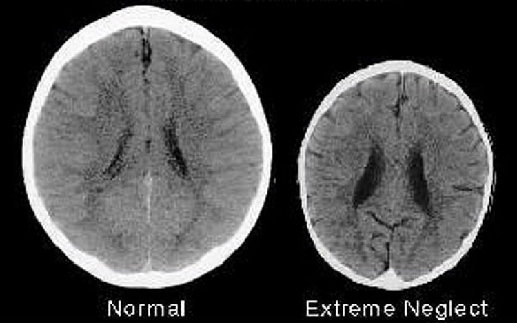 Read more about the article The Effects of Child Neglect Demonstrated in Two Shocking Brain Scans