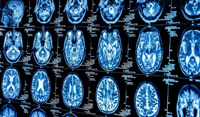 Read more about the article 4 Types of Depression Revealed from Over a Thousand Brain Scans