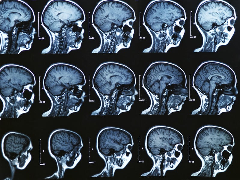 psychopaths brain differences