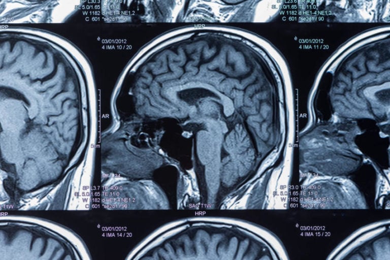 Read more about the article 24-Year-Old Woman with Half Her Brain Missing Confounds Doctors